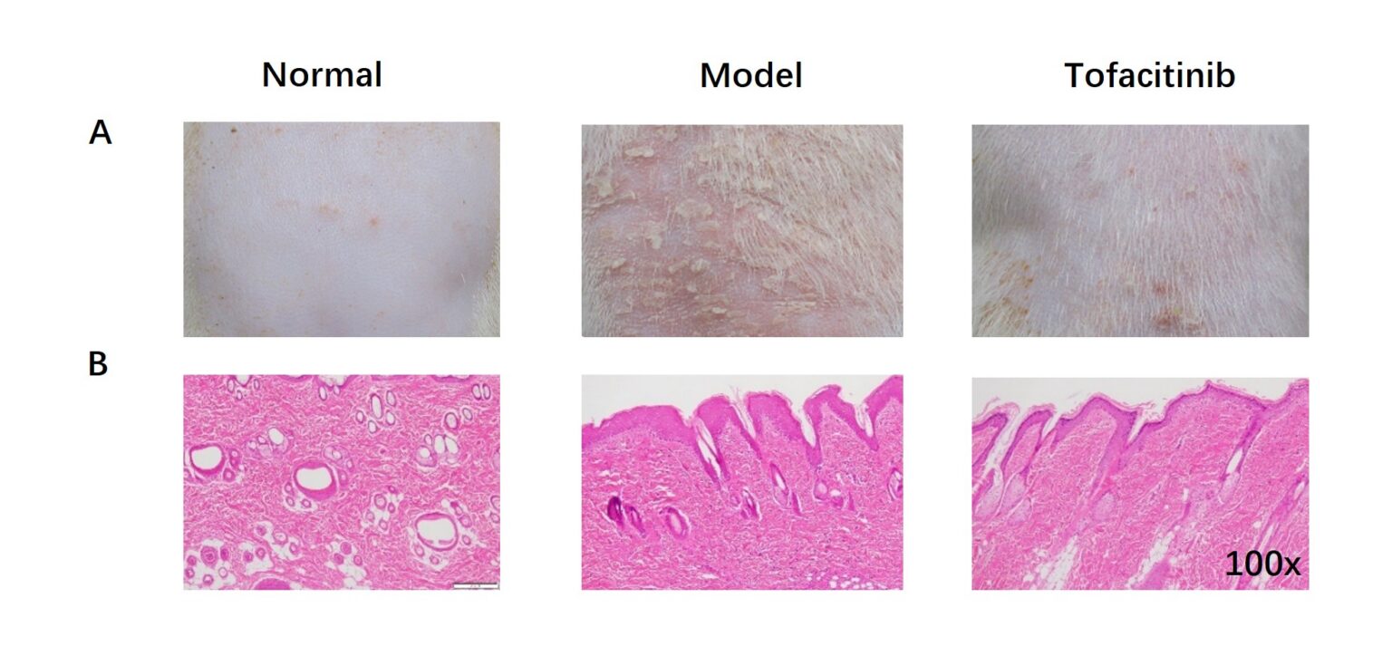 psoriasis: pathogenesis, treatment, and evolving disease models 6 Figure 4 Psoriasis Blog