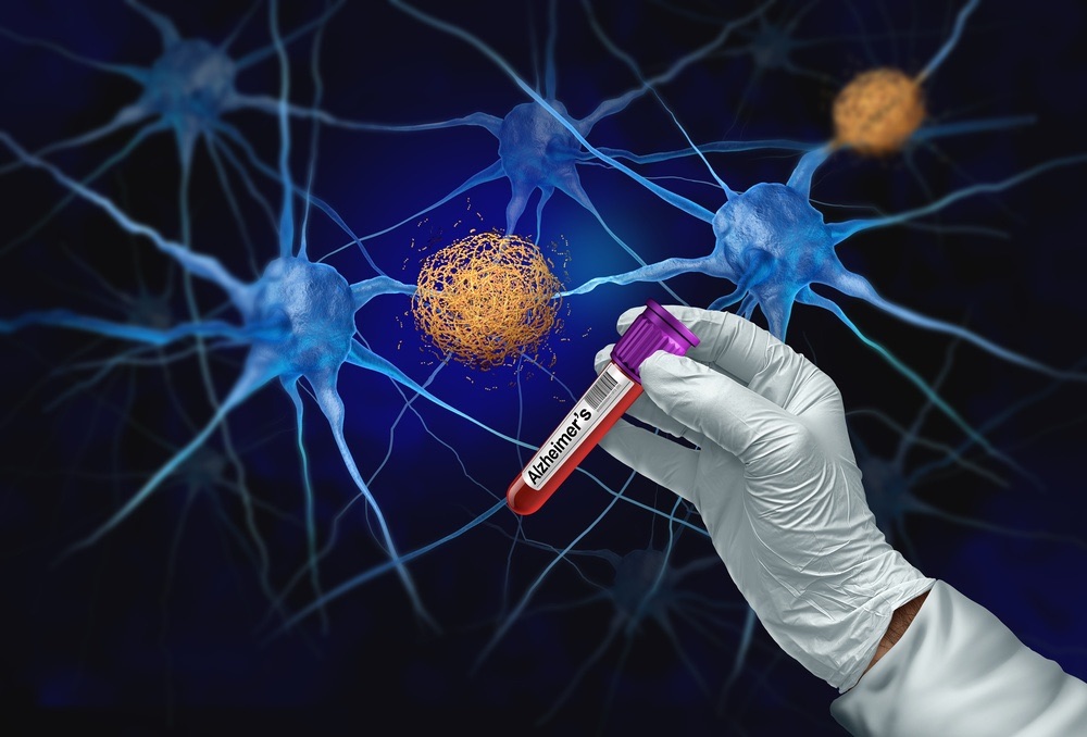 Alzheimers Disease Biomarkers Blog