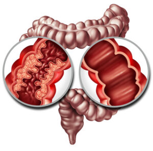 Crohn Syndrome Disease Or Crohns Illness And Healthy Colon As A Medical Concept With A Close Up Of A Human Intestine With Inflammation Symptoms Causing Obstruction As A 3D Illustration.